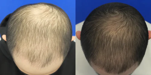 Antes y después